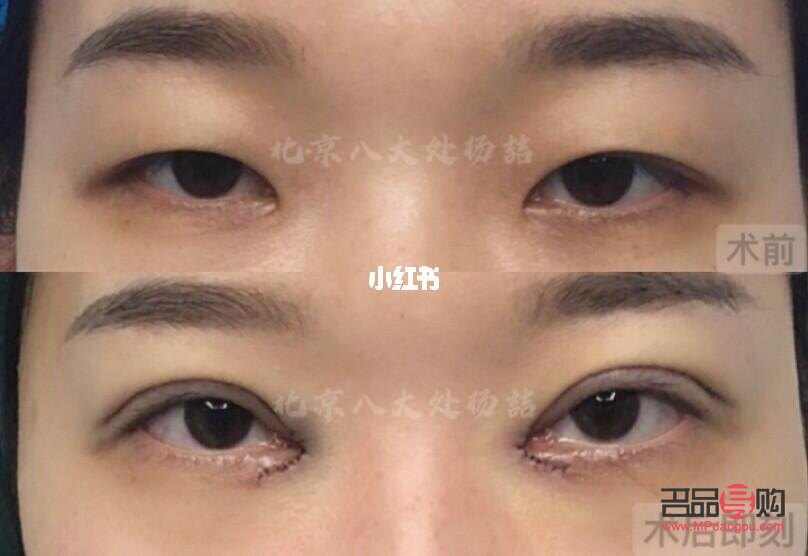 小眼睛開眼角雙眼皮效果(小眼睛開眼角雙眼皮效果好嗎)