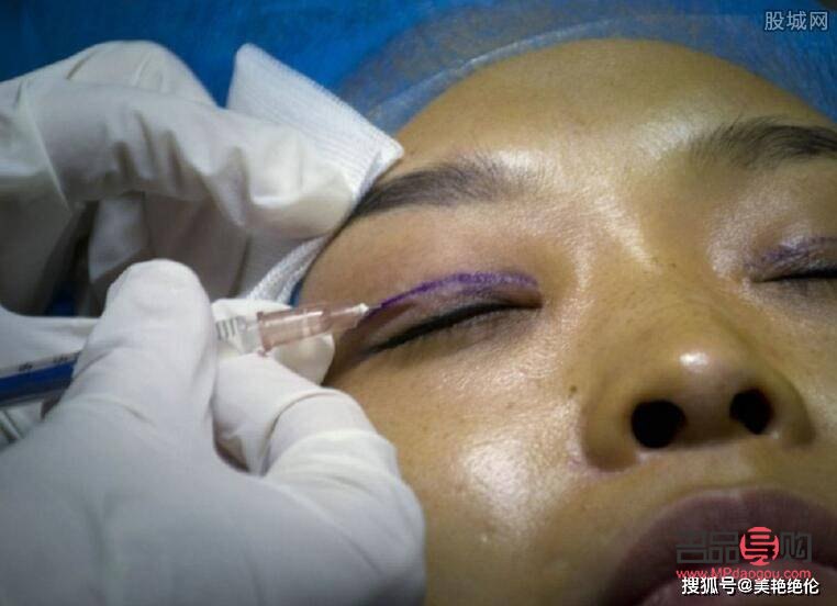 割雙眼皮多久能恢復(fù)正常(割雙眼皮多久能恢復(fù)正常飲食)