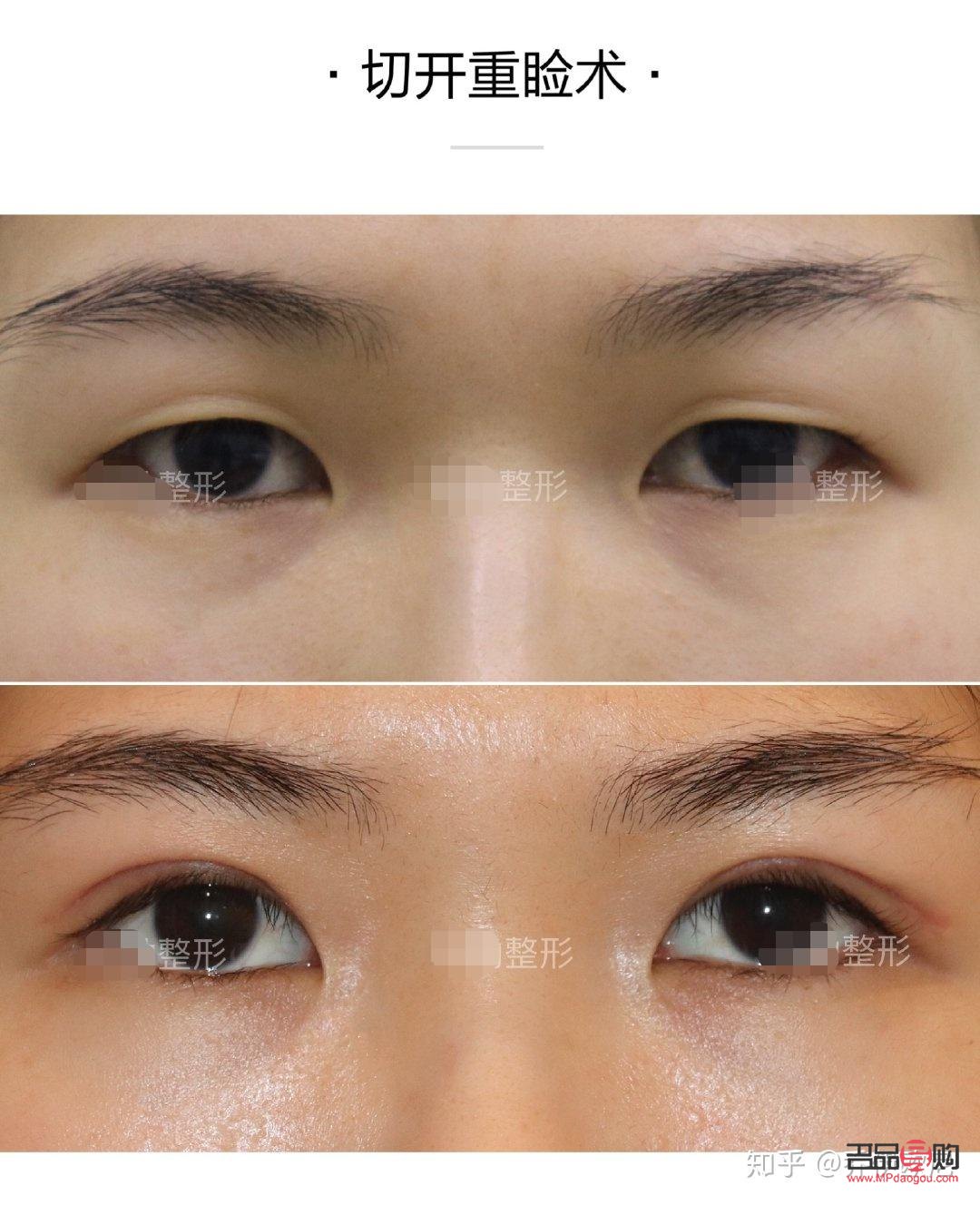 割雙眼皮多久能恢復(fù)正常(割雙眼皮多久能恢復(fù)正常飲食)