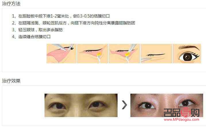 去眼袋多少錢標(biāo)準(zhǔn)收費(fèi)(提眉術(shù)價(jià)格一般是多少)