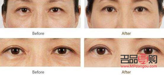 去眼袋多少錢標(biāo)準(zhǔn)收費(fèi)(提眉術(shù)價(jià)格一般是多少)