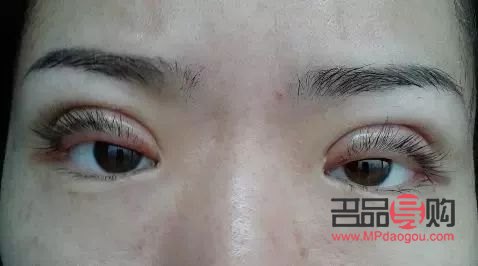 應(yīng)對(duì)過(guò)敏引發(fā)的上眼皮紅腫問(wèn)題