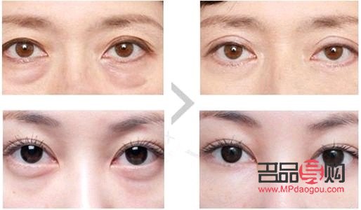 <h3>探究眼袋成因及治療方法</h3>