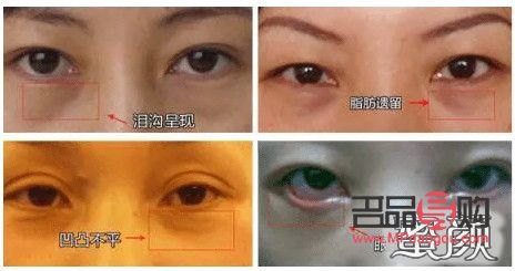 探究眼袋成因及治療方法