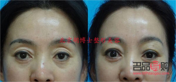 <h3>上眼瞼凹陷改善方法大揭秘</h3>