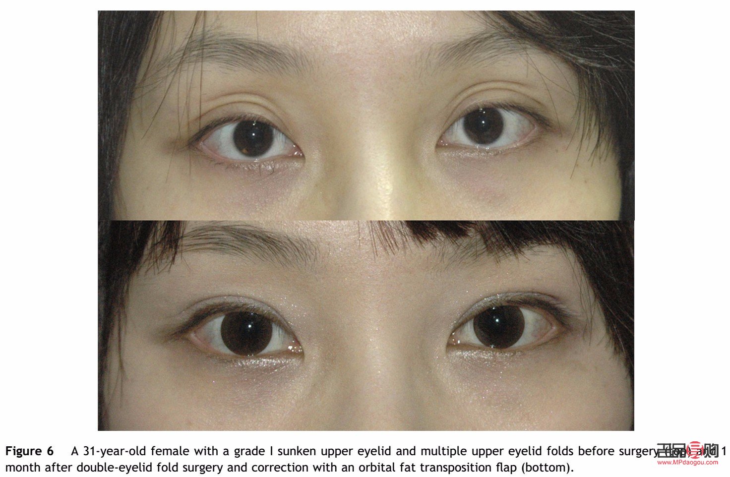 <h3>上眼瞼凹陷改善方法大揭秘</h3>