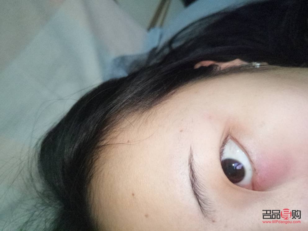 眼睛下面紅腫疼是什么原因(眼睛下面紅腫疼是什么原因引起的)