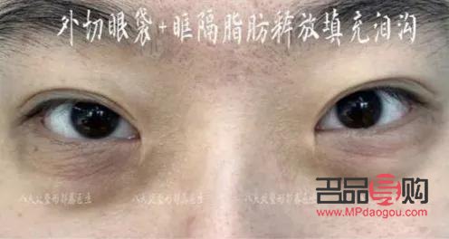 眼袋大是哪里出問題了(眼睛腫眼袋大是哪里出問題了)