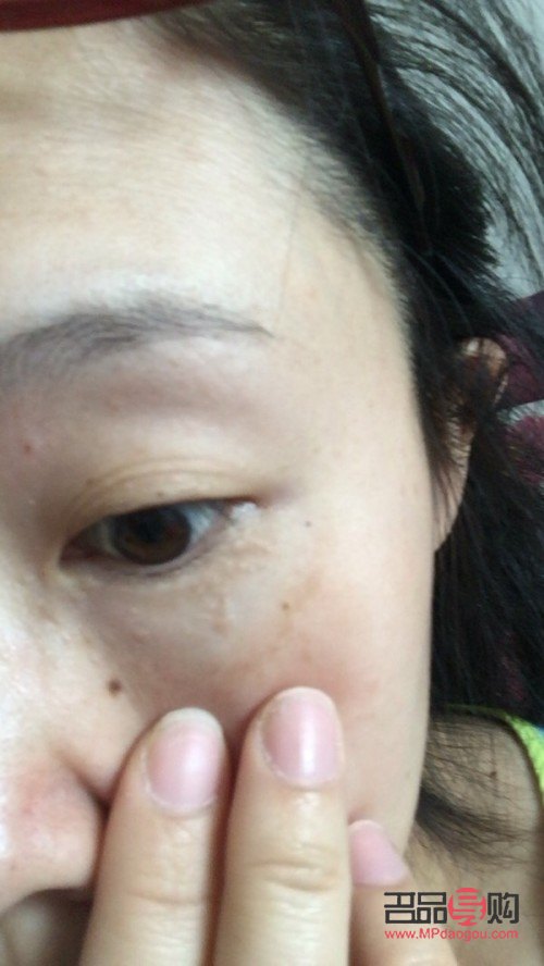 上眼皮長了個疙瘩圖片(上眼皮長了個疙瘩圖片不疼不癢)