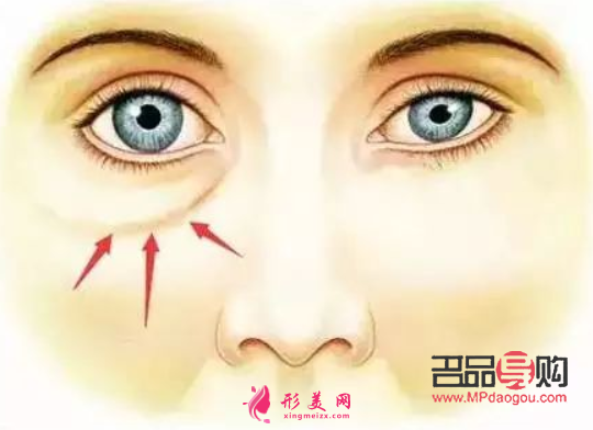 眼袋手術(shù)完全恢復(fù)要多久(眼袋手術(shù)完全恢復(fù)要多久時間)