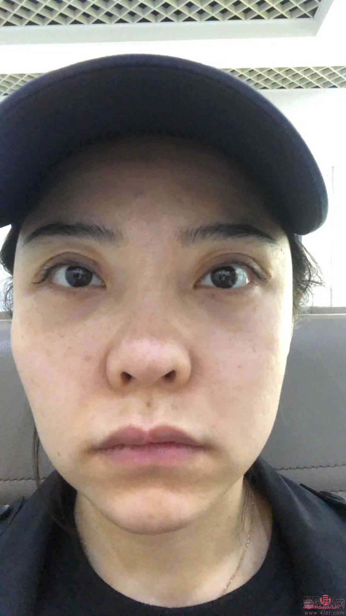 <h3>眼睛大小不一，手術(shù)可否解決？</h3>