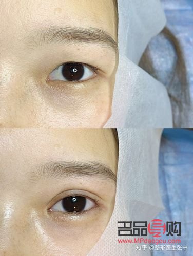 眼部抽脂有什么風(fēng)險(xiǎn)和后遺癥(腫眼泡去脂肪手術(shù)多少錢)