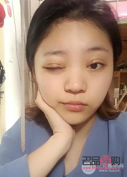 <h3>雙眼皮手術(shù)20天恢復(fù)圖詳解</h3>