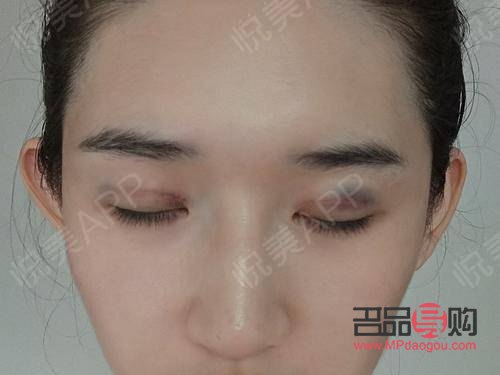 <h3>提眉與埋線雙眼皮：可否一并施行？</h3>