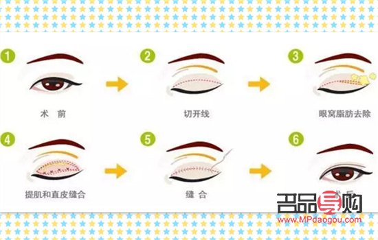 <h3>提眉與埋線雙眼皮：可否一并施行？</h3>