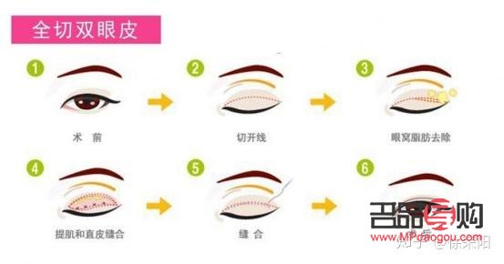 眼皮松全切雙眼皮會(huì)不會(huì)塌(眼皮松全切雙眼皮會(huì)不會(huì)塌下去)