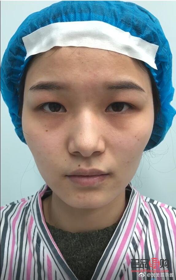 眼皮松全切雙眼皮會(huì)不會(huì)塌(眼皮松全切雙眼皮會(huì)不會(huì)塌下去)