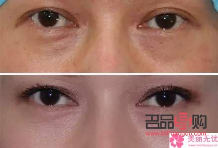 上眼皮松弛可以割嗎多少錢(上眼皮松弛可以割嗎多少錢啊)