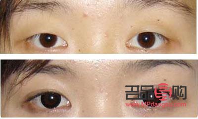 現(xiàn)在做雙眼皮的有哪種方式好(現(xiàn)在做雙眼皮的有哪種方式好呢)