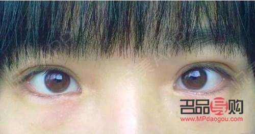 全切雙眼皮與眼綜合：深度解析兩者的差異