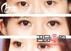 割雙眼皮對(duì)身體有什么影響(割雙眼皮對(duì)身體有什么影響嗎)