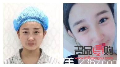 眼睛矯正手術(shù)大概多少錢住幾天住(眼睛矯正手術(shù)價格表)