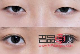 眼睛矯正手術(shù)大概多少錢住幾天住(眼睛矯正手術(shù)價格表)