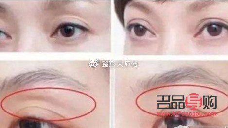 眼窩凹陷可以填充嗎？解析眼部填充手術(shù)