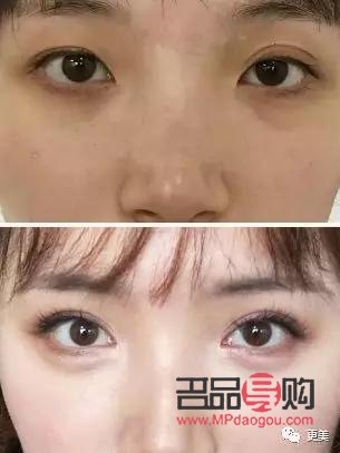 <h3>歐式雙眼皮的魅力與特色</h3>