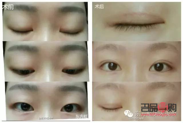 <h3>內雙是否可以割雙眼皮及手術費用詳解</h3>