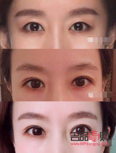 全切雙眼皮恢復(fù)過(guò)程全解析