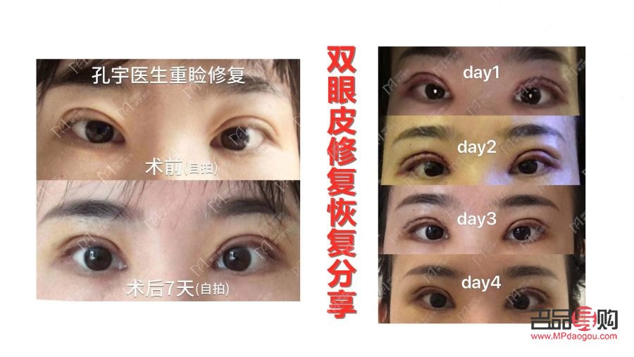全切雙眼皮恢復(fù)過(guò)程全解析