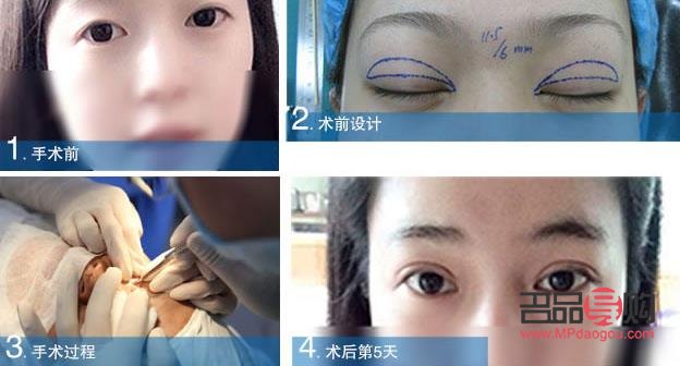 全切雙眼皮恢復(fù)過(guò)程全解析