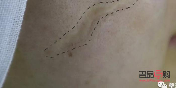 什么是縫美容針(美容縫合針是什么樣的)