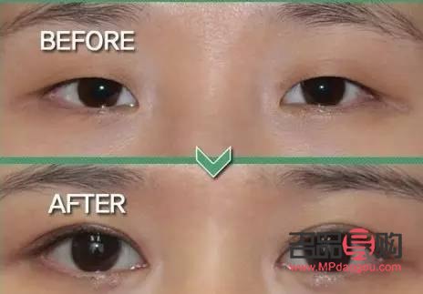 做哪種雙眼皮(做哪種雙眼皮是永久的)