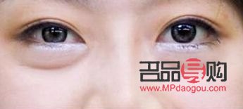 后天腫眼泡怎么消除好幾年了圖片(后天腫眼泡怎么消除好幾年了圖片)