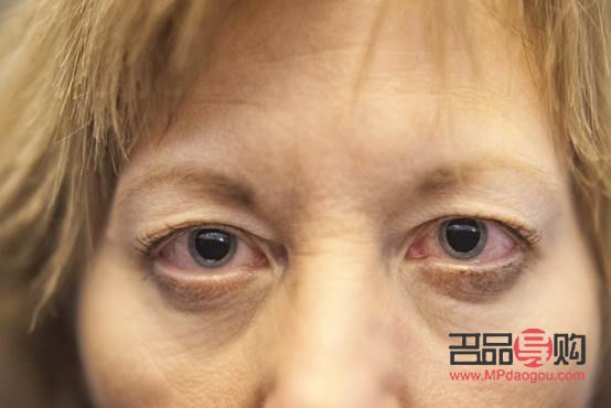 淚溝消除秘籍：告別疲憊，重拾青春明眸