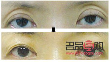 眼窩凹陷嚴重圖片(眼窩凹陷嚴重圖片兒童)