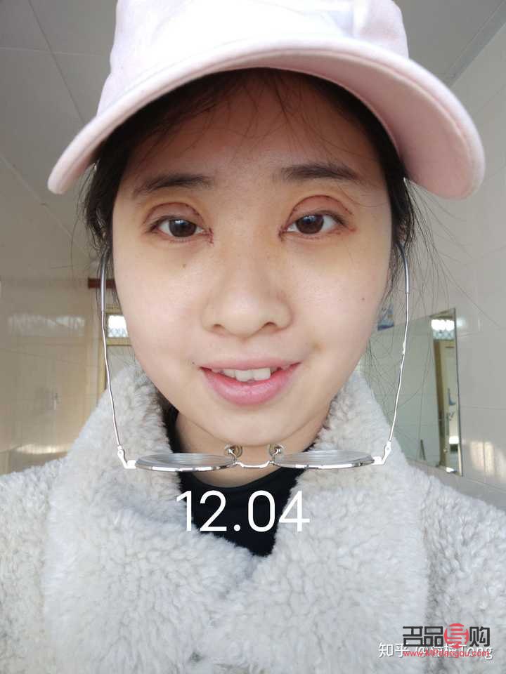 雙眼皮全切恢復(fù)期要多久才自然(雙眼皮全切恢復(fù)期要多久才自然好)