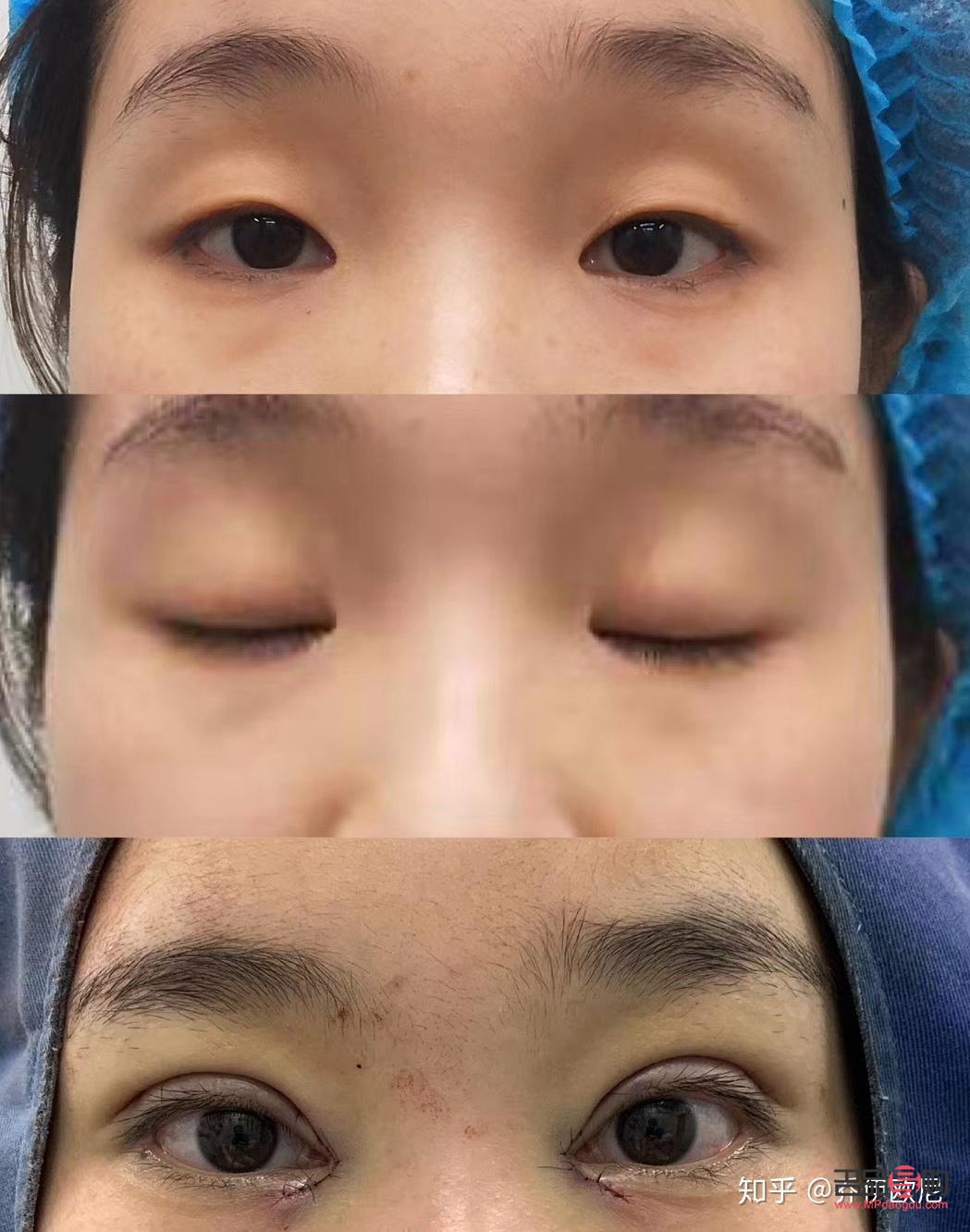 雙眼皮全切恢復(fù)期要多久才自然(雙眼皮全切恢復(fù)期要多久才自然好)