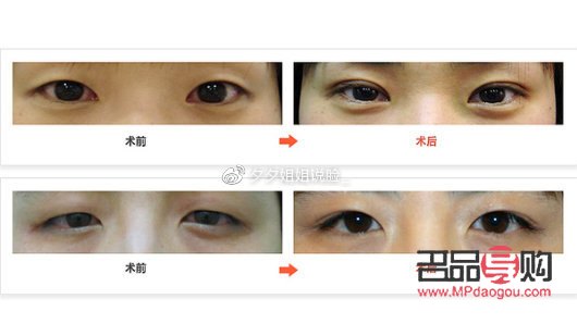 割的雙眼皮能維持幾年(埋線雙眼皮20年后圖片)