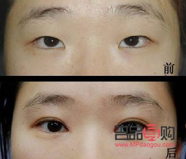 割的雙眼皮能維持幾年(埋線雙眼皮20年后圖片)