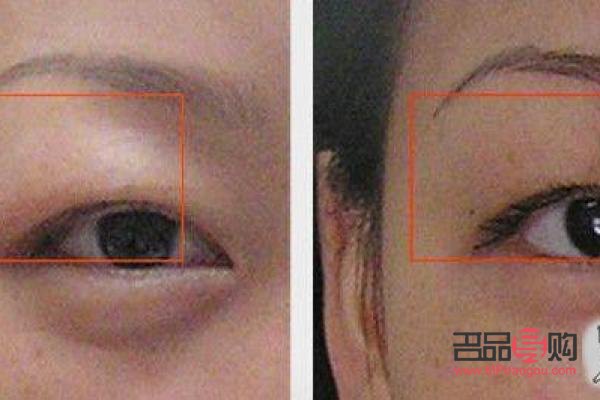 眼睛陷進去怎么辦(眼睛陷進去怎么辦小妙招)