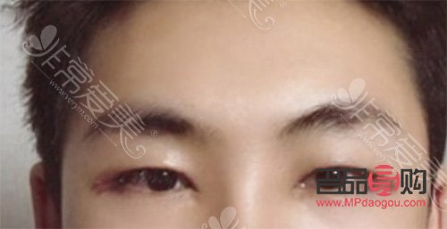 <h3>男人是否應該割雙眼皮？探討男性雙眼皮手術的利與弊</h3>