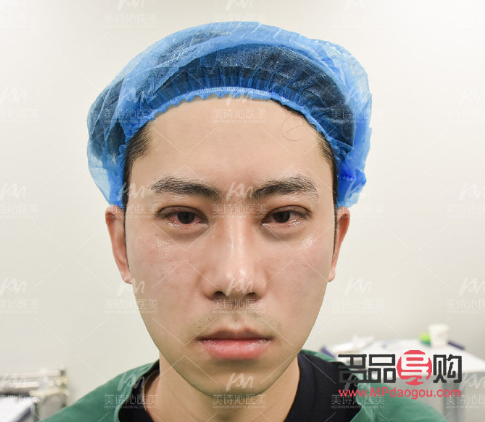 <h3>男人是否應該割雙眼皮？探討男性雙眼皮手術的利與弊</h3>