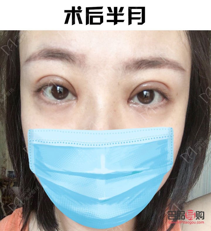 全切雙眼皮注意事項(全切雙眼皮注意事項及護理)