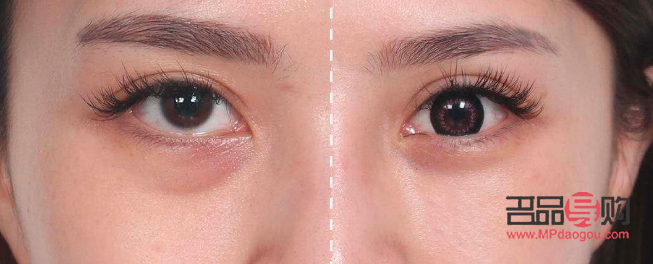 割眼袋增生了怎么辦(割眼袋增生了怎么辦圖片)