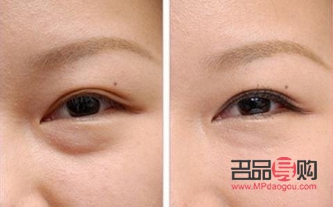 眼部超聲刀怎么做(眼部超聲刀做完什么時候見效果)