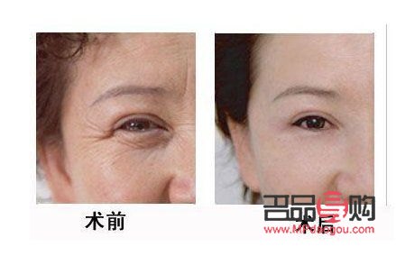 眼部超聲刀怎么做(眼部超聲刀做完什么時候見效果)