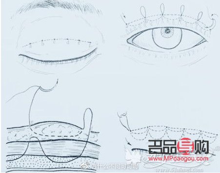 不適合做雙眼皮埋線的人群